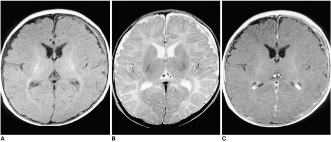 Shaken Baby Syndrome MRI
Chronic subdural hematoma (SDH) in a three-month-old female patient 
A T1-weighted image shows mainly low-signal SDH, with a high signal focus in the left frontal area