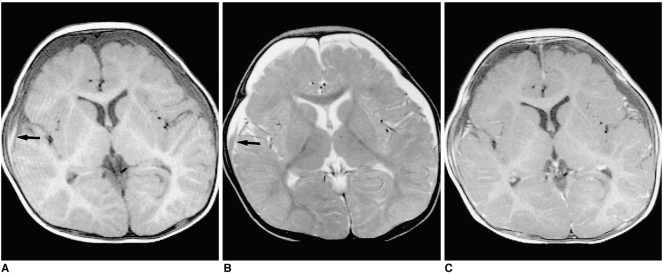 Shaken Baby Syndrome MRI
Chronic Subdural Hematoma in an eight-month-old male patient
A; T1-weighted image shows low-signal SDH in both frontal areas. A high signal area, suggesting subacute hemorrhage, may also be observed in the right frontal area (arrow)
B; On a T2-weighed image, the signal intensity of the SDH is mainly high, though there is a focal area of low intensity (arrow)
C; Contrast-enhanced T1-weighted image shows diffuse linear dural enhancement