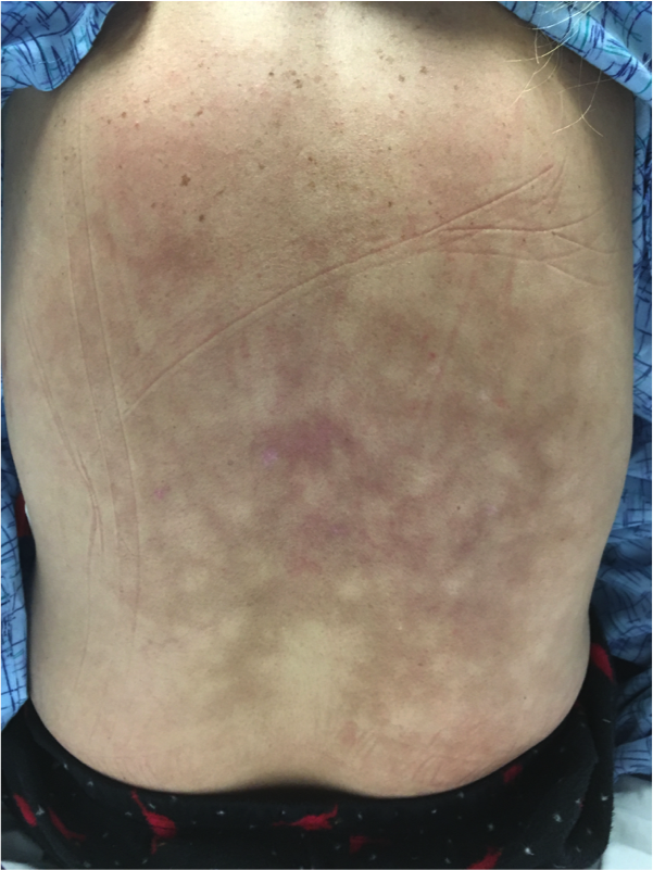 <p>Erythema ab Igne, Back</p>