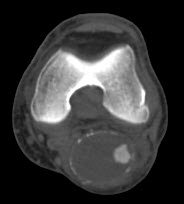 Pre-Operative CTA Left Popliteal Artery Aneurysm