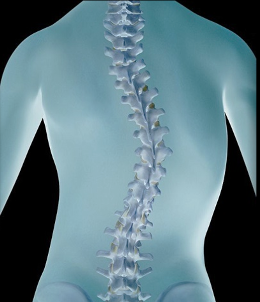 scoliosis of the spine