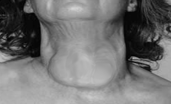 <p>Goiter in a Female</p>