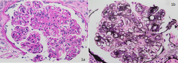 Renal Biopsy, HIVICK
PAS stain