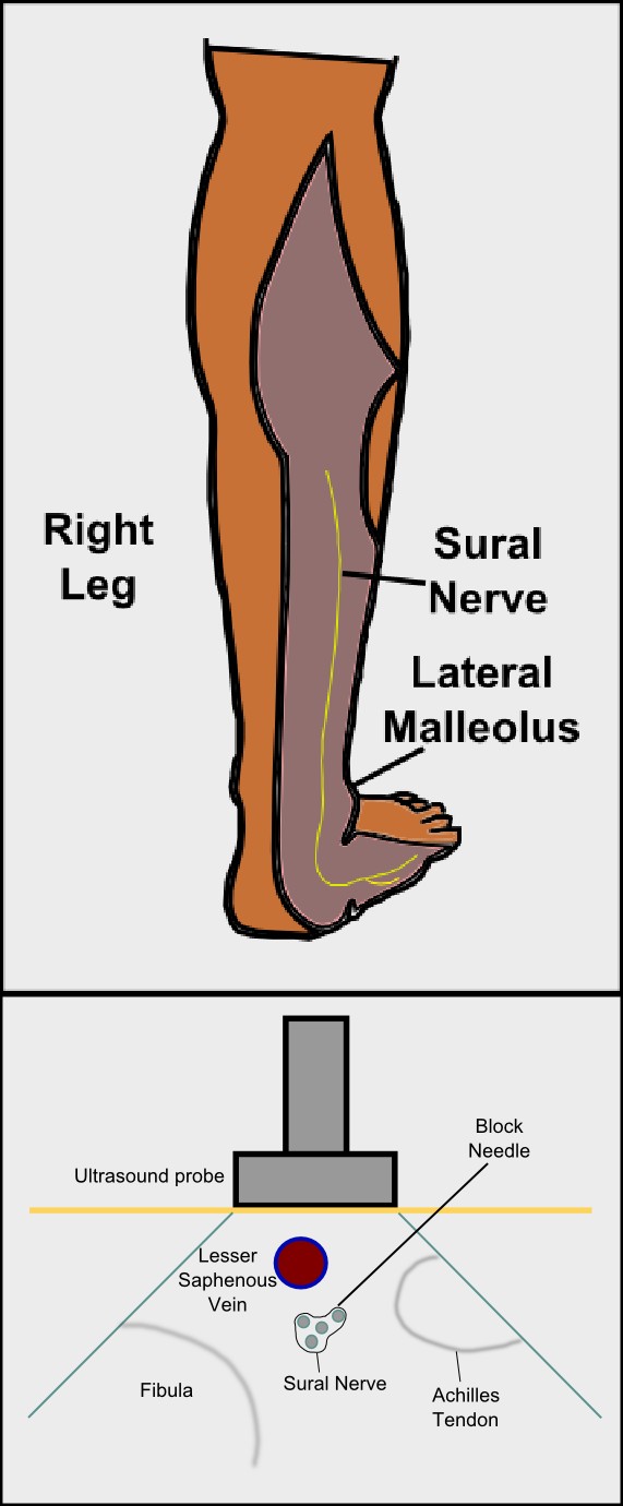 Sural Nerve Block Figures