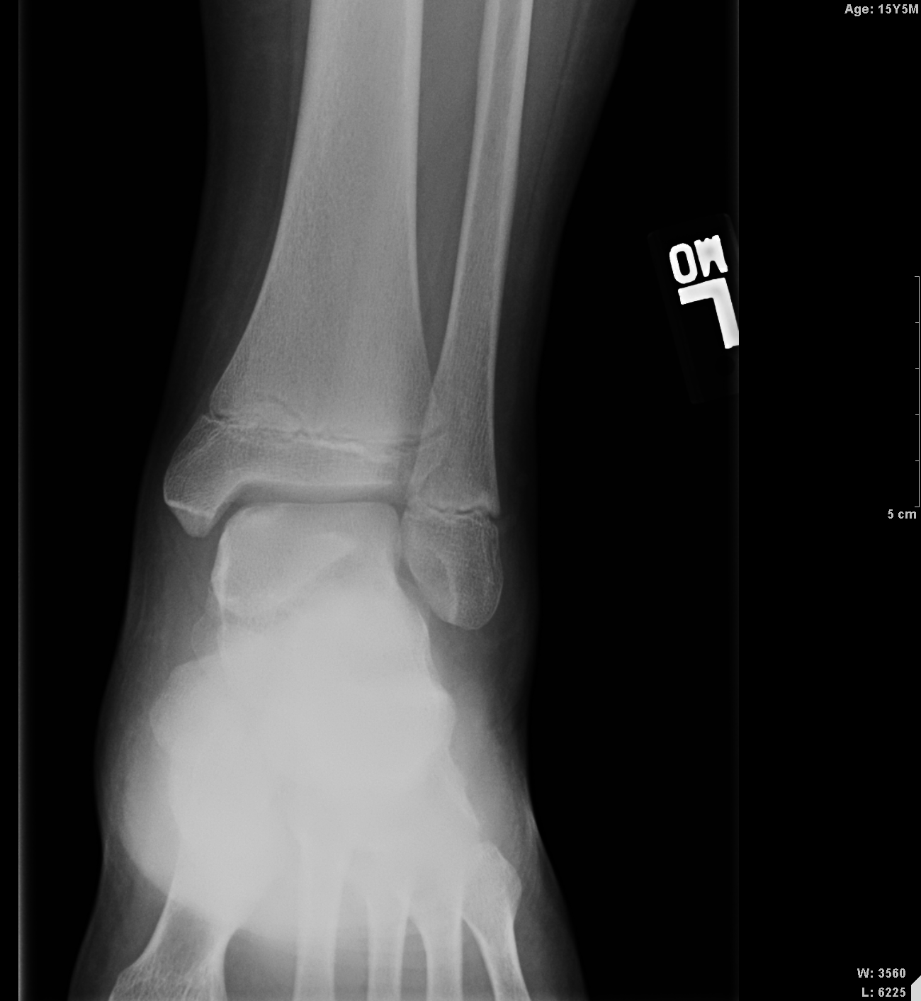 AP radiograph ankle - talus osteochondritis dissecans