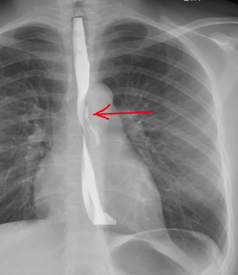 Perforation of the esophagus