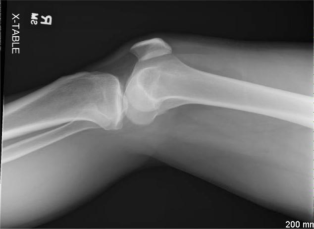 Figure 1: Horizontal cross table lateral view plain radiograph of the knee with a fat fluid level in the supra-patellar recess compatible with a lipohemarthrosis