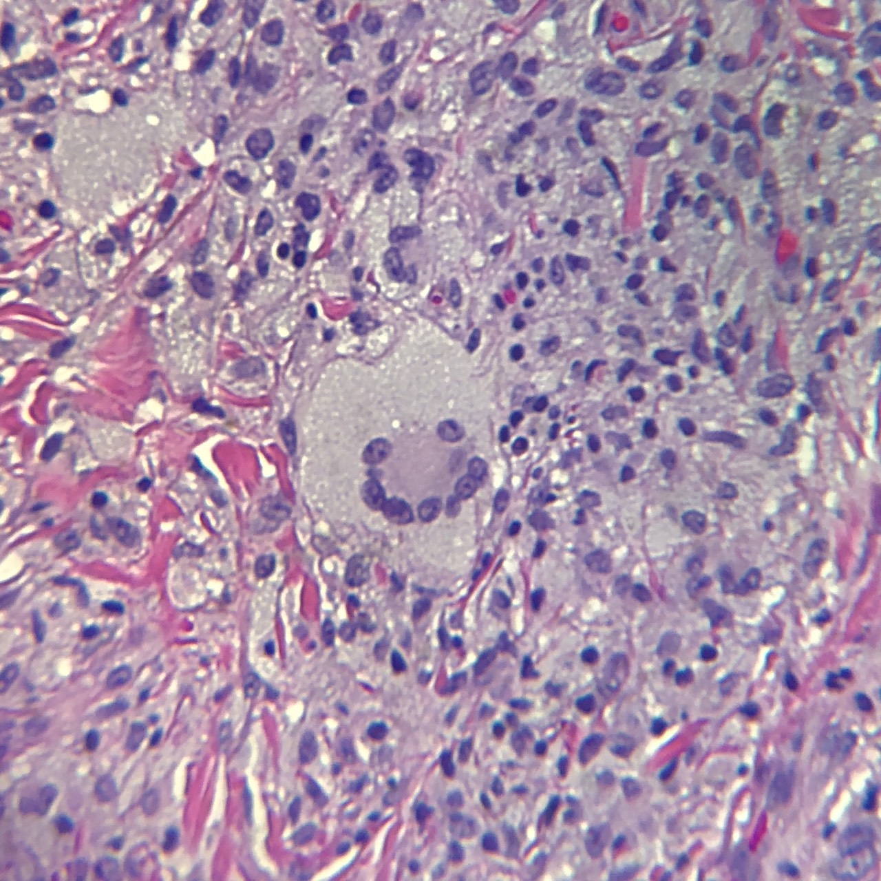 Classic multinucleated (Touton) giant cell of juvenile xanthogranuloma (JXG).