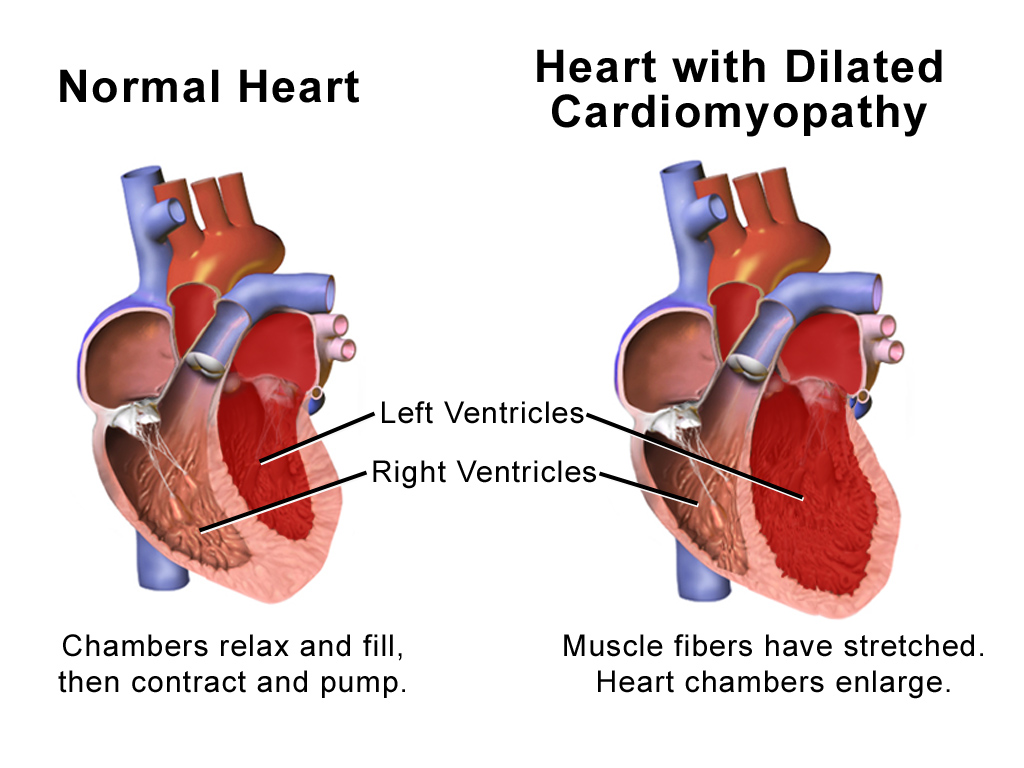 Cardiac Dilated Cardiomyopathy