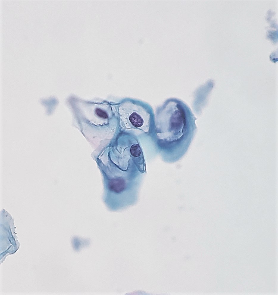 Koilocytes on a Papanicolaou stain of cervical cells.