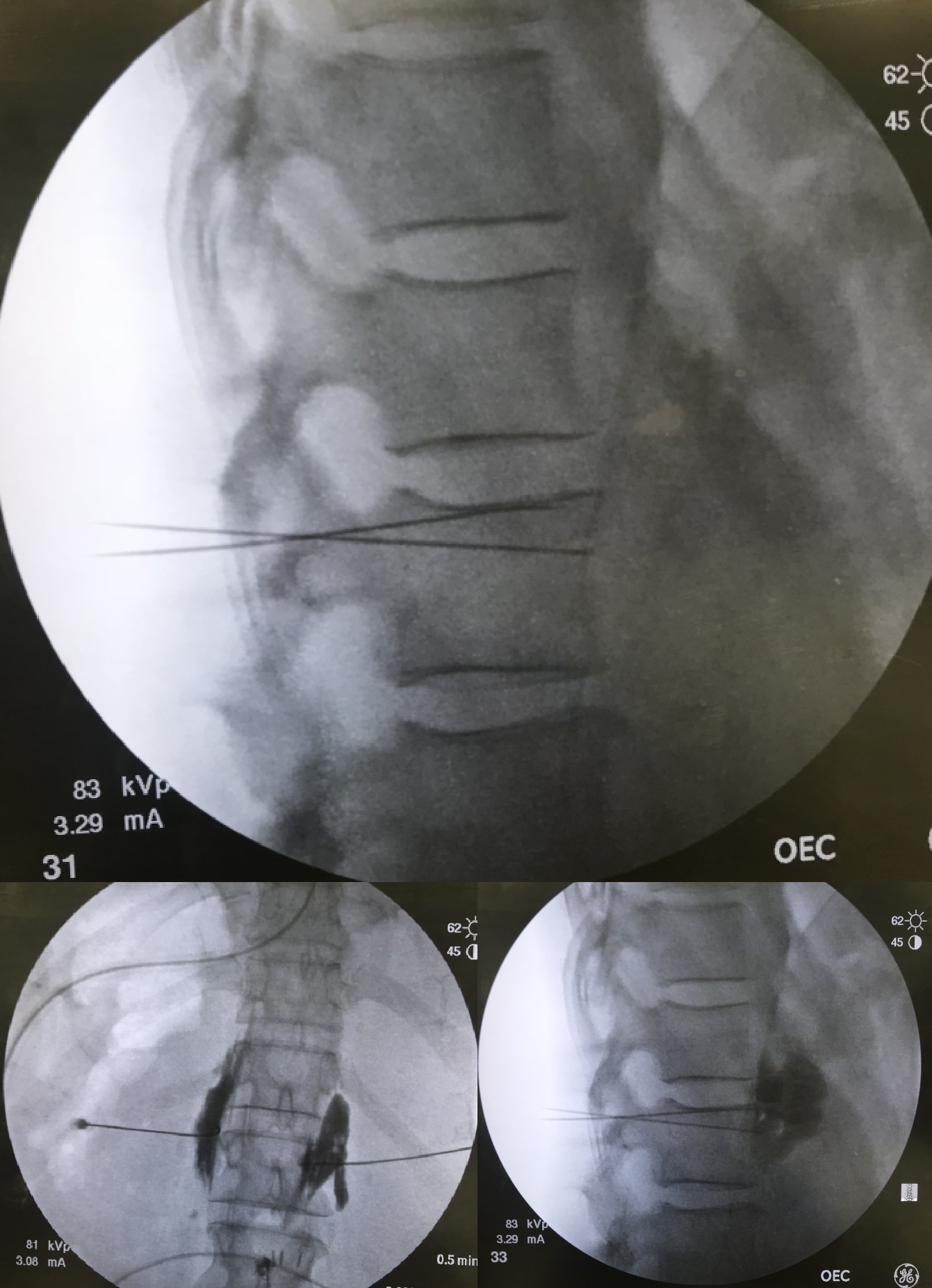 <p>Neurolytic Celiac Plexus Block, Radiograph. Posterior Approach Lateral View (1,2) and AP view (3)</p>