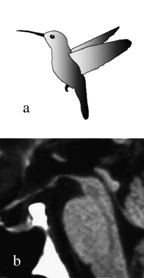 <p>Rostral Midbrain Atrophy in Progressive Supranuclear Palsy