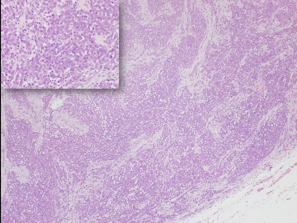 Epithelioid Sarcoma, Proximal-Type. Inset shows rhabdoid cells with prominent nucleoli.