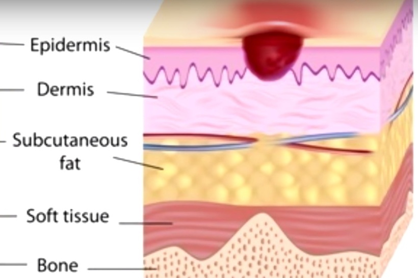 Stage 2: erythema with the loss of partial thickness of the skin including epidermis and part of the superficial dermis.