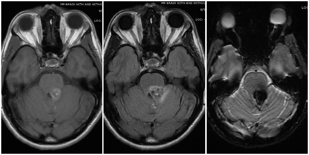 Magnetic resonance imaging depicts a cavernous malformation in the left middle cerebellar peduncle of a patient who presented with right sided facial numbness and ataxia. Varying signal intensities on T1- and T2-weighted sequences and detection of blood on susceptibility weighted sequences (left, middle, and right images, respectively) that are characteristic for a cavernoma are seen. Imaging findings consistent with a Zabramski type 2 cavernoma with mixed signal intensities on both type 1 and type 2, giving it the "popcorn appearance".
