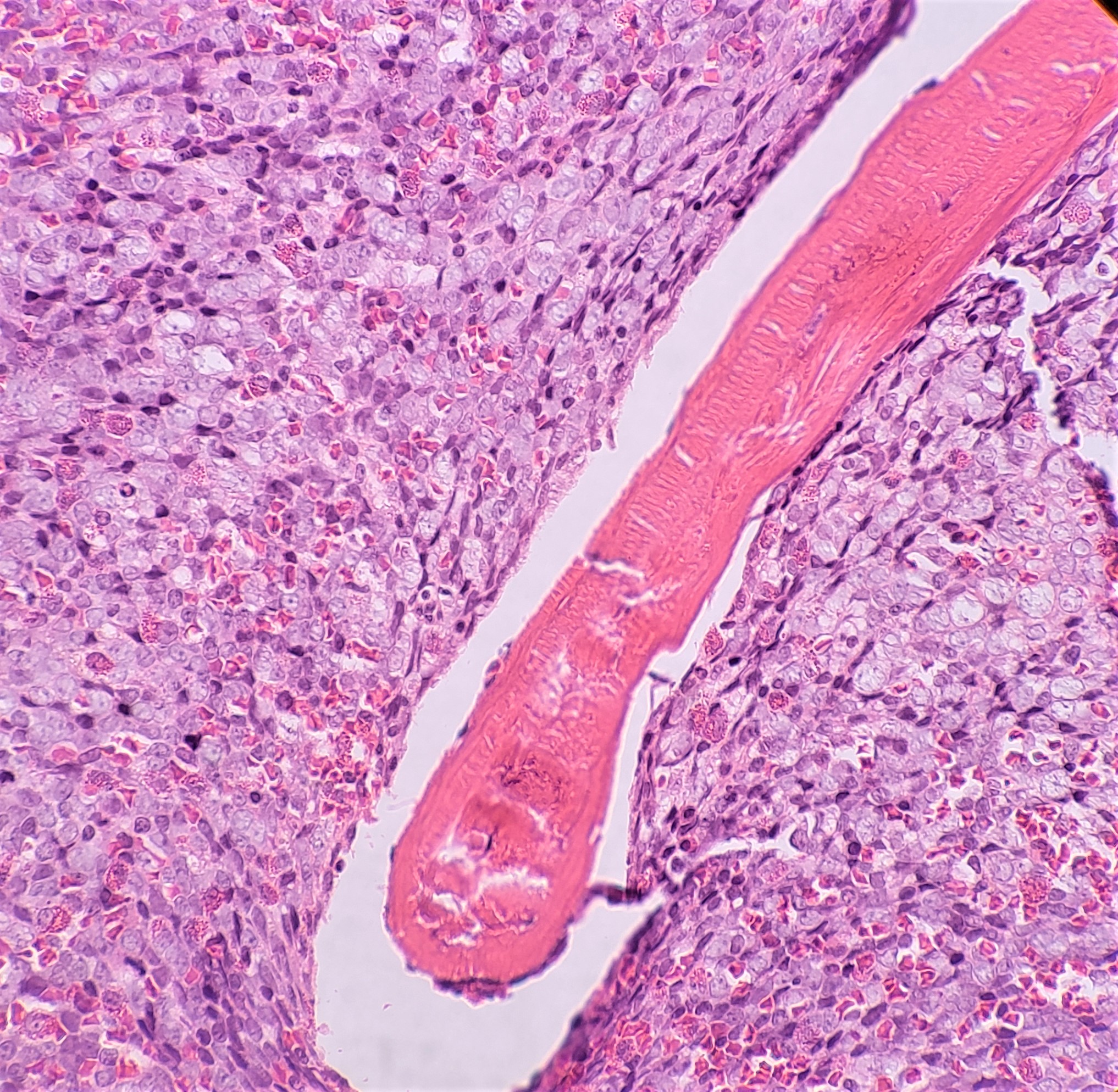 Blast phase Chronic Myeloid Leukemia