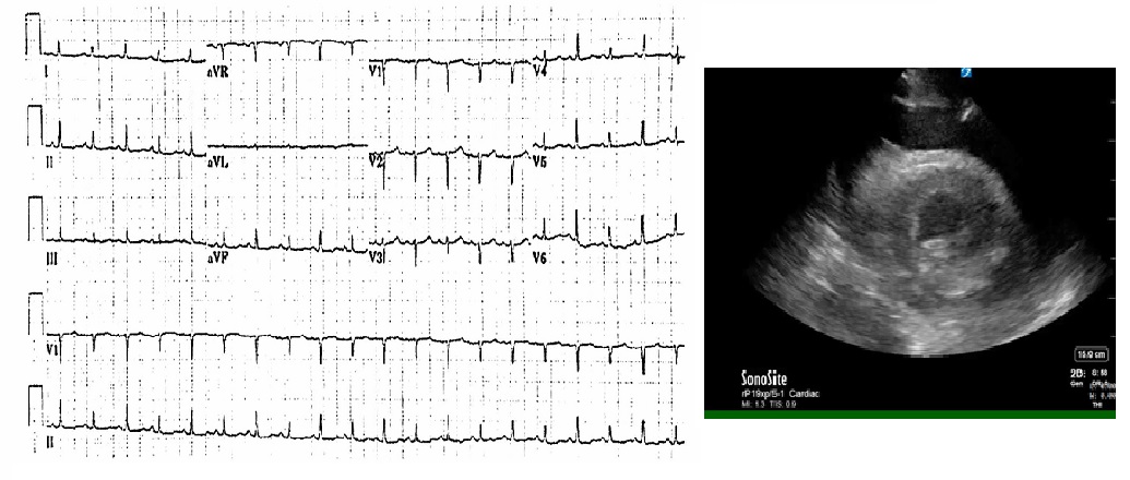 ECG of electrical alternans