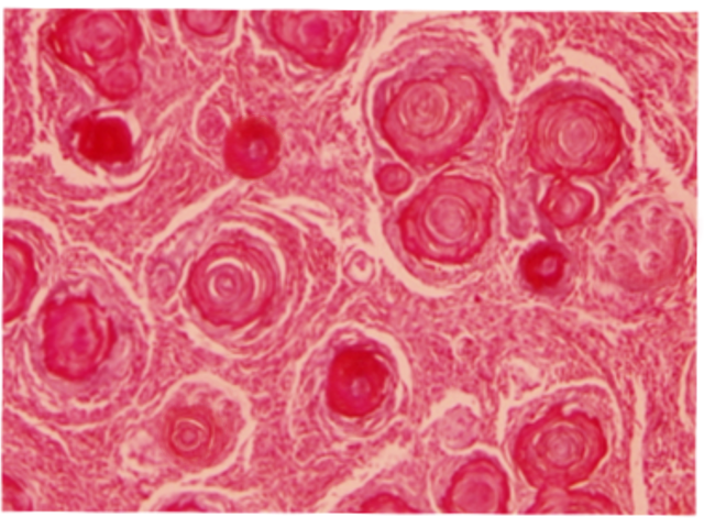 Psammamo bodies in meningioma