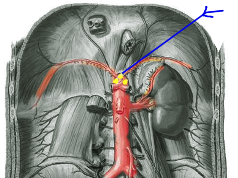 <p>Celiac Plexus Block</p>