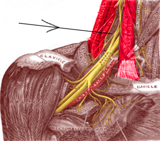 <p>Interscalene Block</p>