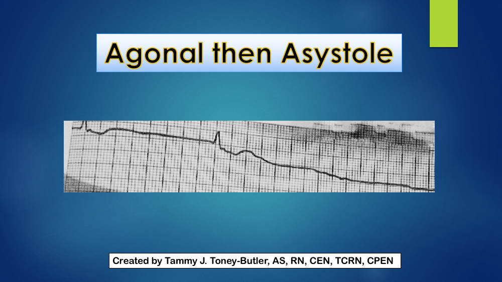 Agonal then Asystole Cardiac Rhythm Strip