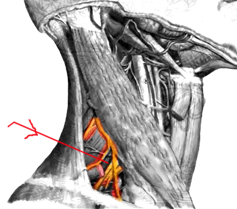 <p>Interscalene Block</p>