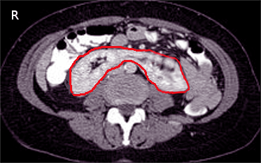 CT scan of horseshoe kidney