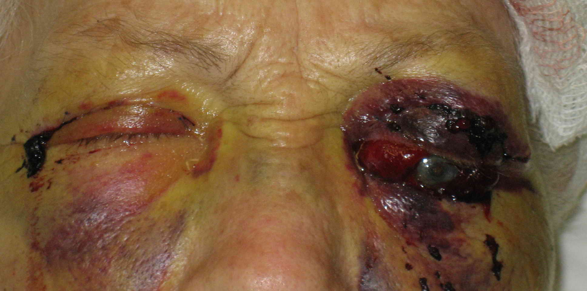 <p>Retrobulbar Hematoma