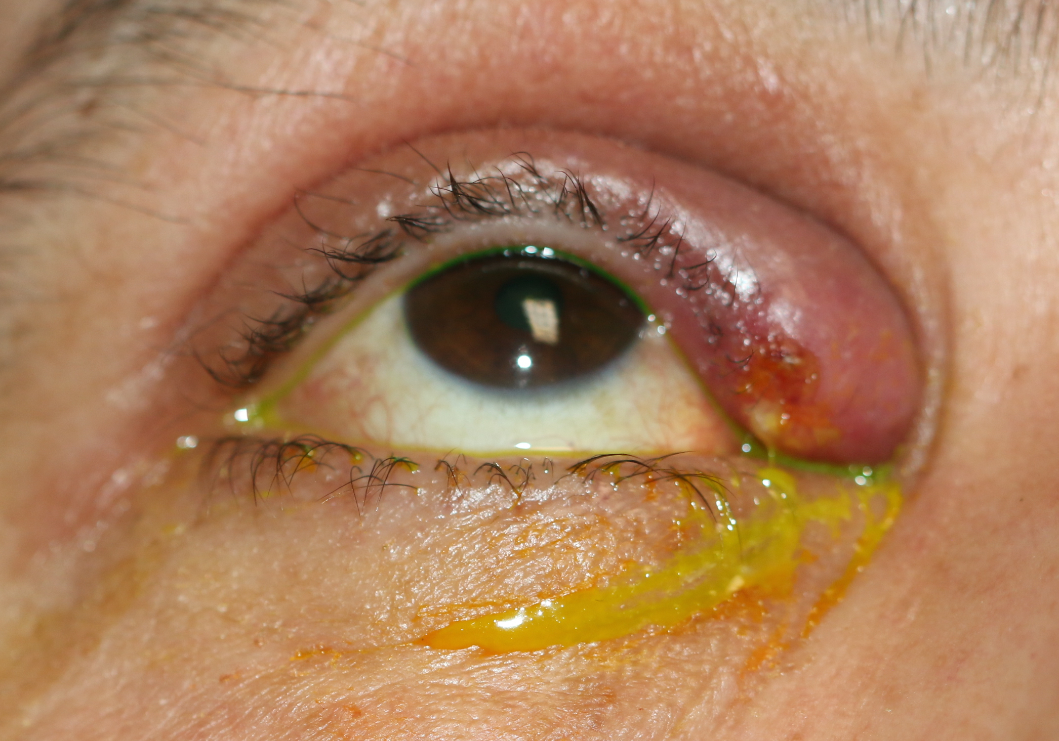 Upper canaliculitis with swelling of the medial upper eyelid, mucoid discharge from the upper punctum and a history of previous placement of a Herrick intra-canalicular plug. The intracanalicular plug was removed via an open dacryocystorhinostomy and the debris within the canaliculus was removed.