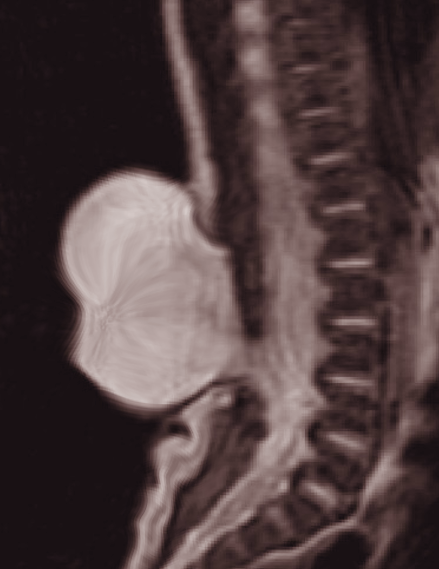 Spinal dysraphism
