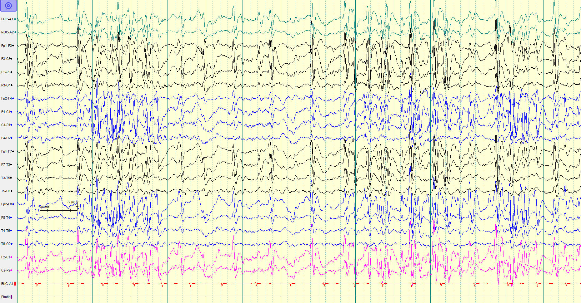 Lennox-Gastaut Syndrome