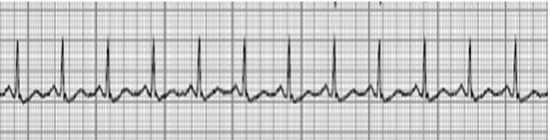 <p>ECG Findings of Hypercalcemia. The QT intervals appear shortened, PR intervals prolonged, and the QRS complex widened.</p>