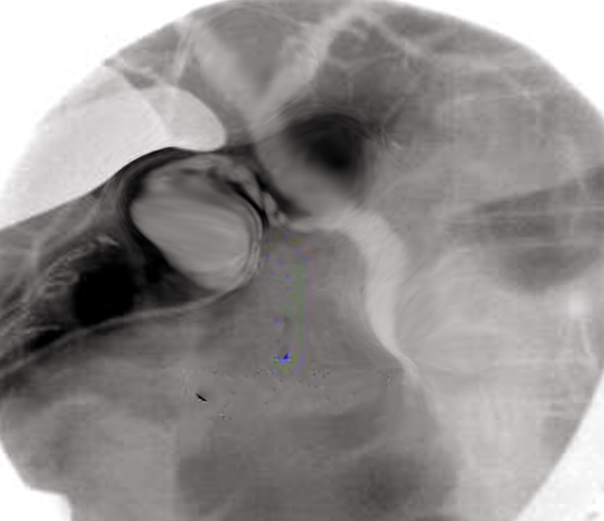 <p>Percutaneous Transhepatic Cholangiography.</p>