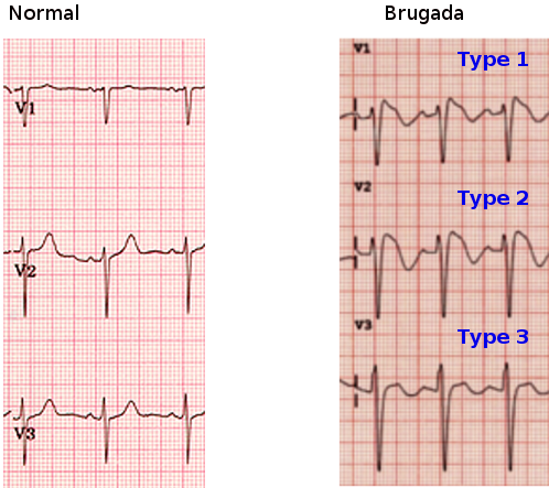 Brugada syndrome