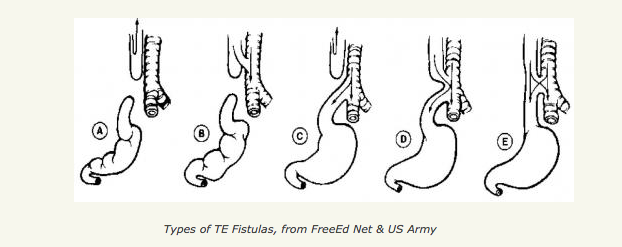 Types of Tracheoesophageal Fistulas