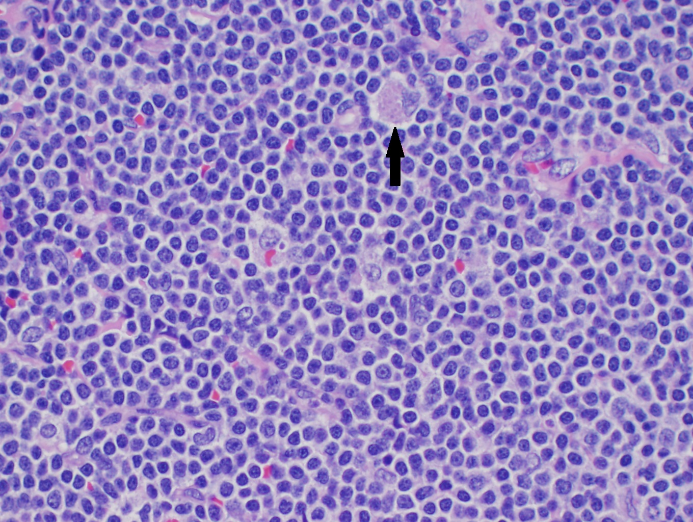 High power H&E of mantle cell lymphoma showing monotonous mature lymphocytes with mildly irregular nuclei.  A pink histocyte is highlighted by the black arrow. 