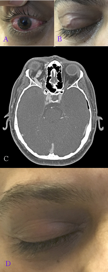 <p>Carotid Cavernous Fistula, Symptoms and Diagnostic Tests