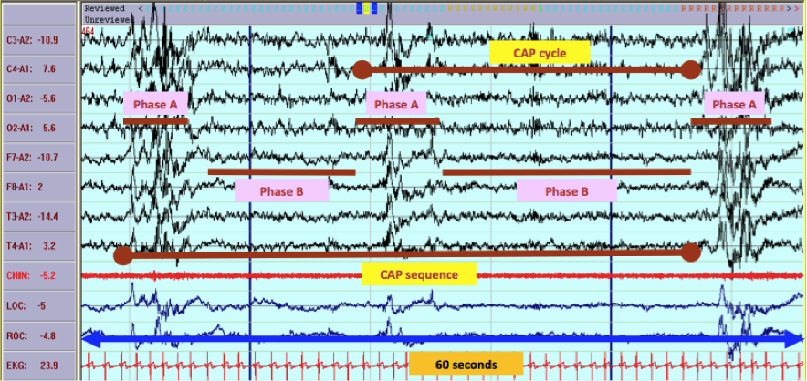 A 60 sec strip of PSG data taken in N2 sleep portraying various Cyclic Alternating Pattern (CAP) Variables