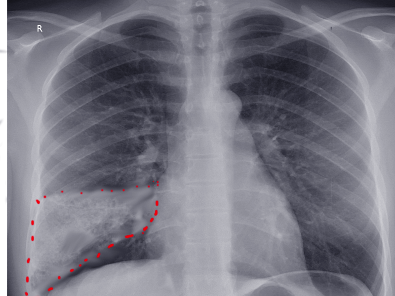 <p>Wedge-Shaped Pulmonary Infarction. A wedge-shaped pulmonary infarction is seen on an anteroposterior chest x-ray.</p>