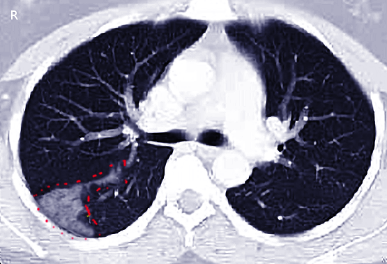 <p>Pulmonary Embolism. A pulmonary embolism causes a pulmonary infarction after a hip fracture.</p>