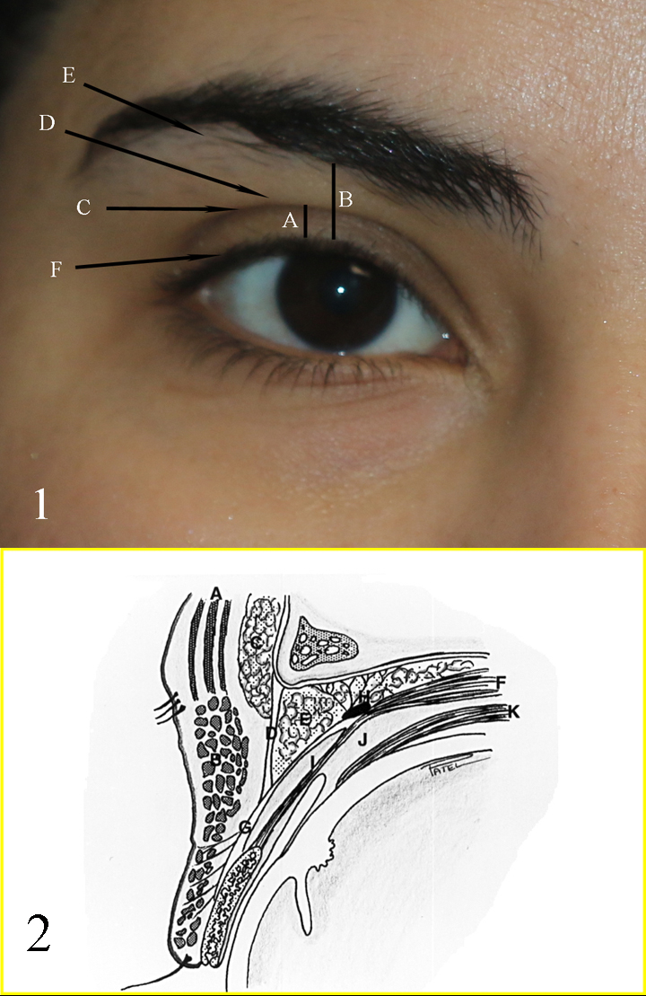 Fig 1: A: upper eyelid platform; B: Brow to Lid margin distance; C: Upper eyelid crease; D: Upper eyelid fold; E: Brow fatpad; F: Eyelid margin and eyelash curve

Fig 2: A: Frontalis muscle; B: Orbicularis muscle; C: Brow fat pad; D: Orbital septum; E: Preaponeurotic fat pads; F: Levator muscle; G: Levator aponeurosis; H: Whitnall ligament; I: Muller muscle; J: Common sheath; K: Superior rectus muscle