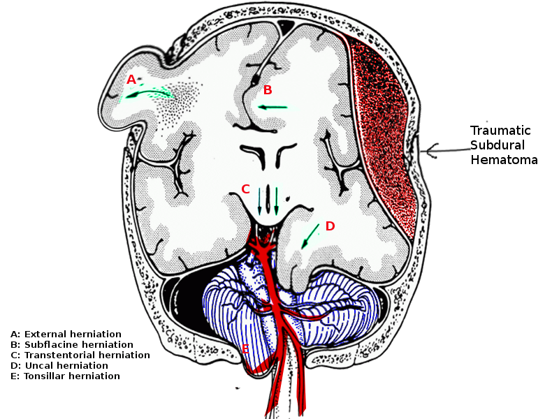 Brain herniation