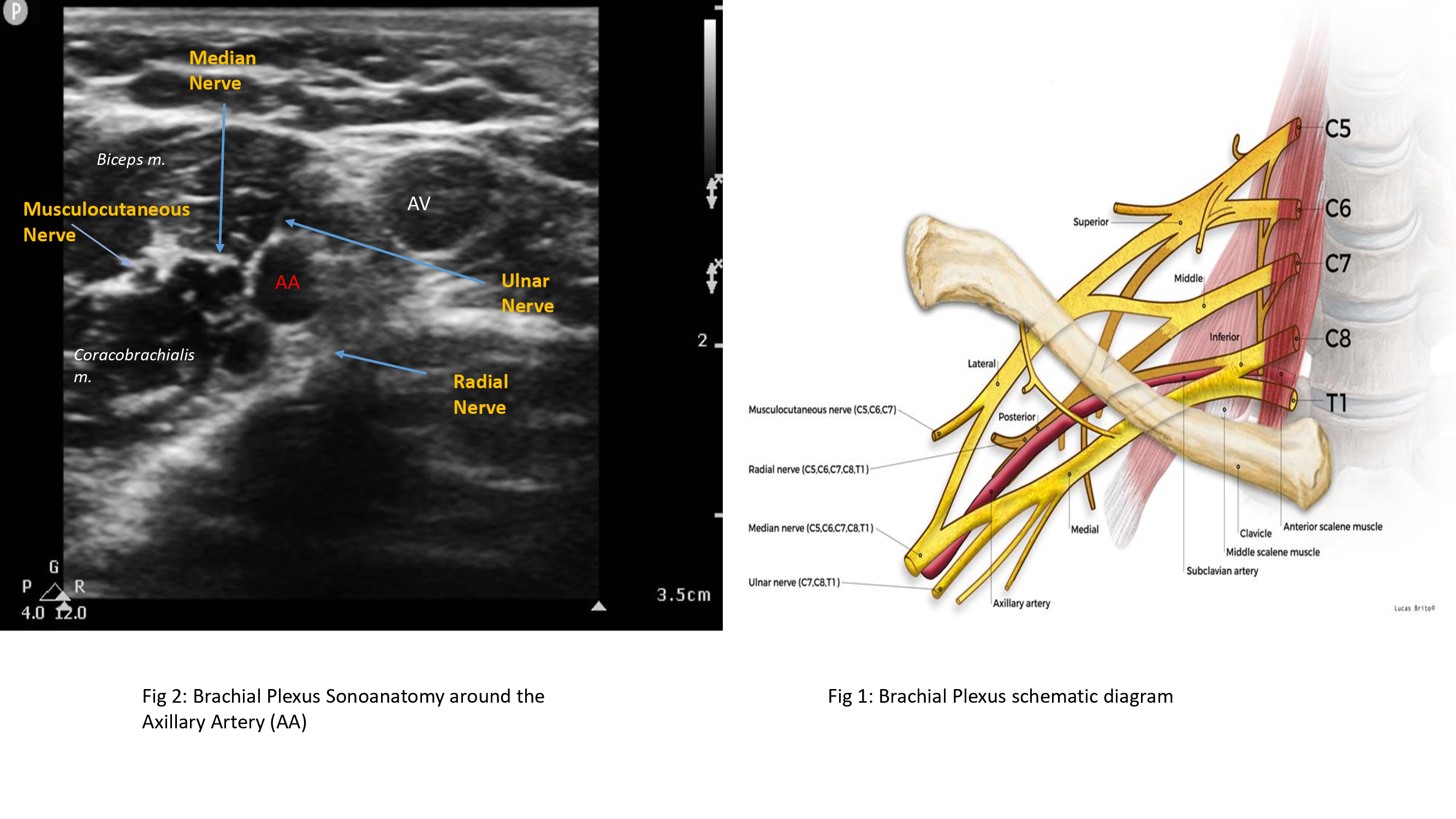 <p>Brachial Plexus Ultrasound and Schematic Diagram