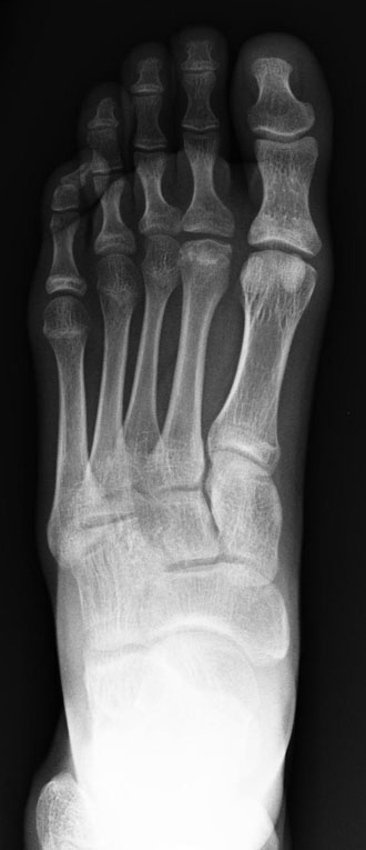 Frontal x-ray of the foot with avascular necrosis of the second metatarsal head (Freibergs disease).