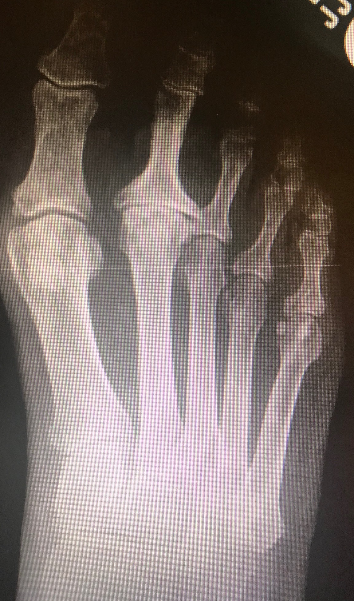 Dorsal-plantar radiograph of the foot with avascular necrosis of the second metatarsal head (Freibergs disease). Smillie classification stage 5 with severe arthrosis, metatarsal head flattening, sclerosis, and joint space obliteration. 