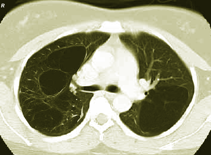 Bullous emphysema-bilateral