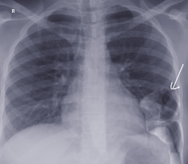 <p>Acquired Diaphragmatic Hernia. Plain radiography&nbsp;of a patient with acquired diaphragmatic hernia.</p>