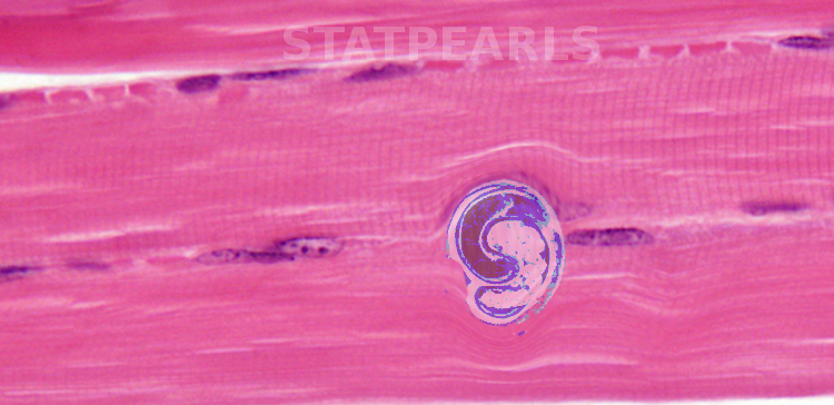 Trichinella spiralis in skeletal muscle