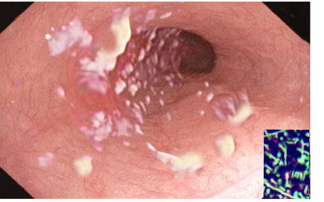 Candida esophagitis