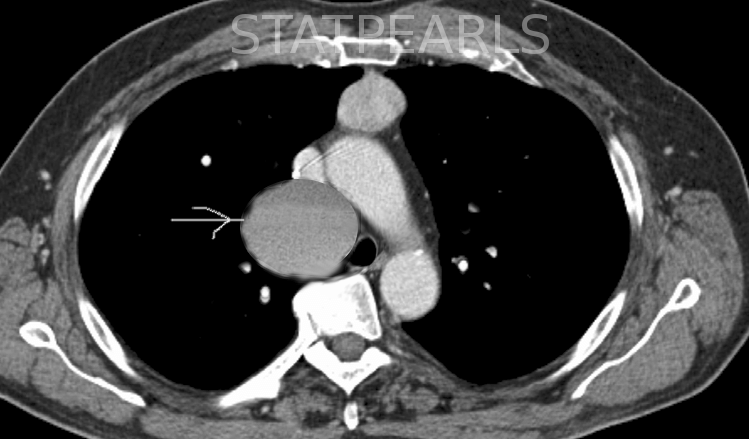 <p>Bronchogenic Cyst, Computed Tomography. These cysts are most commonly located in the mediastinum or lungs.</p>